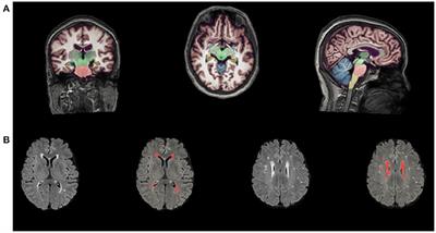 Medial Temporal Atrophy Contributes to Cognitive Impairment in Cerebral Small Vessel Disease